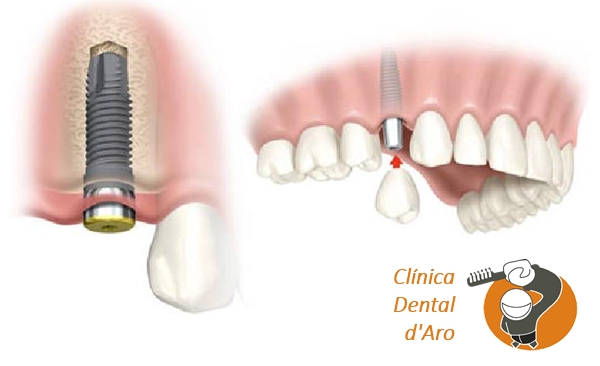 Què són els Implants dentals?